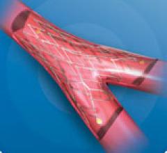 Stents Drug Eluting | DAIC